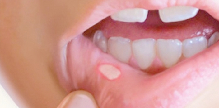 Sintomi celiachia e odontoiatria: che cosa possiamo fare?